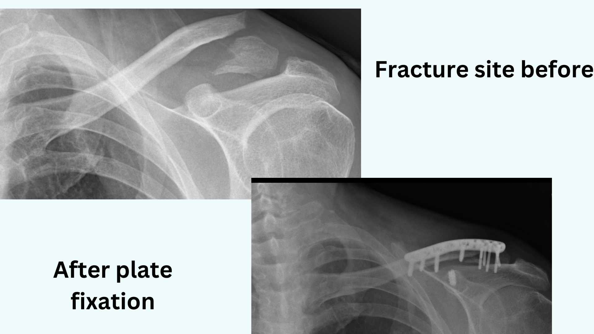 A broken Clavicle (collar bone):Treatment and recovery tips
