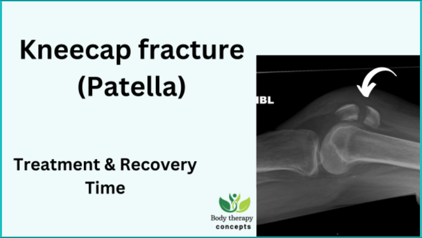 Patella (kneecap) Fracture: Treatment and recovery Tips. What you need ...