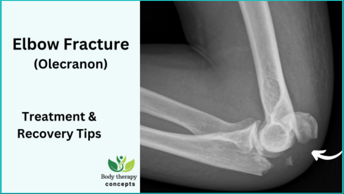 How Long Does It Take For Elbow Fracture To Heal