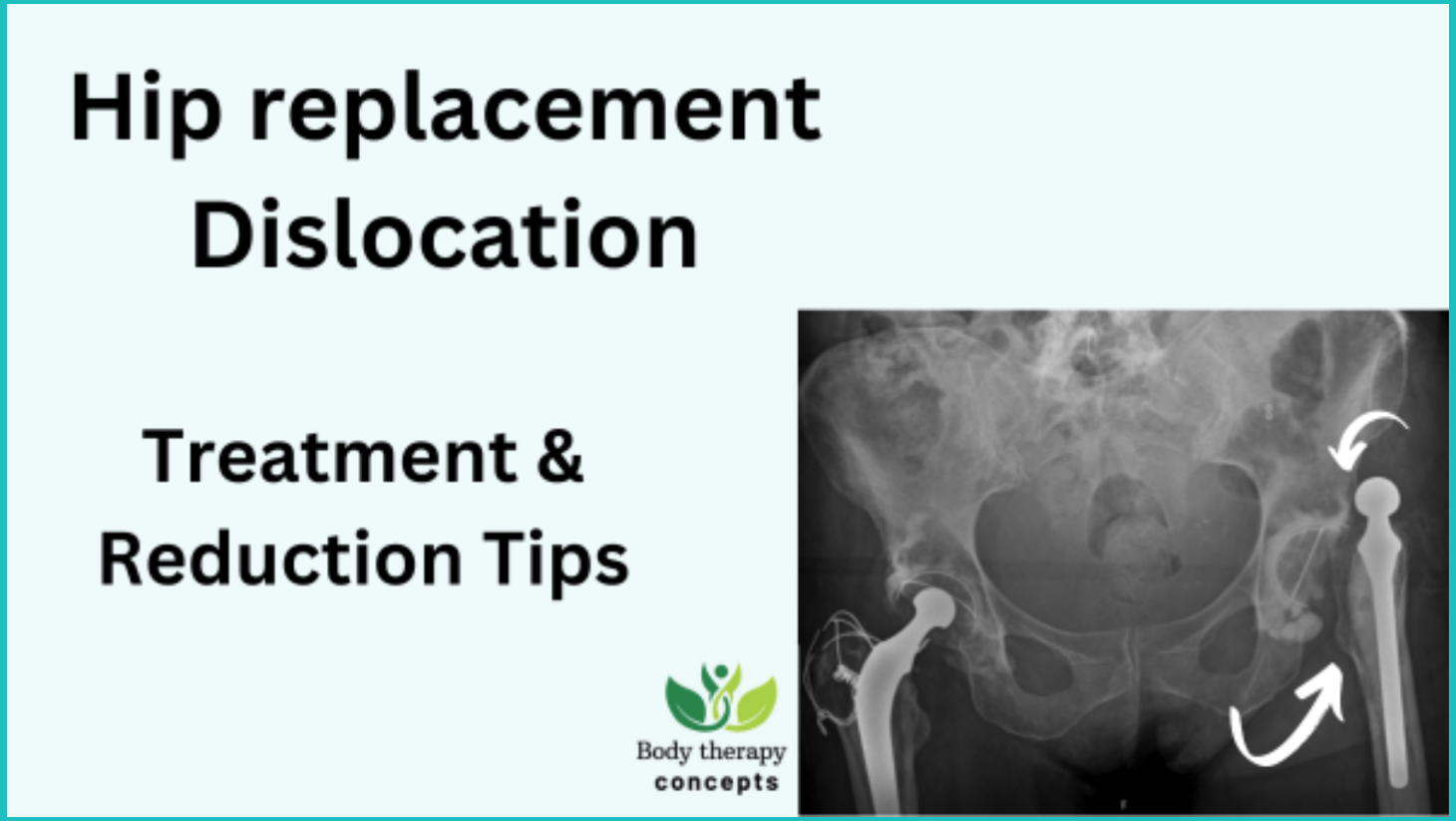 Dislocated hip symptoms, diagnosis, treatment and recovery time.