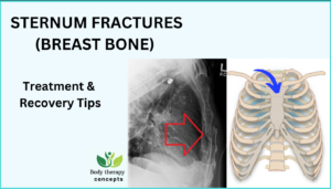 Understanding treatment & recovery tips of sternum fractures ...