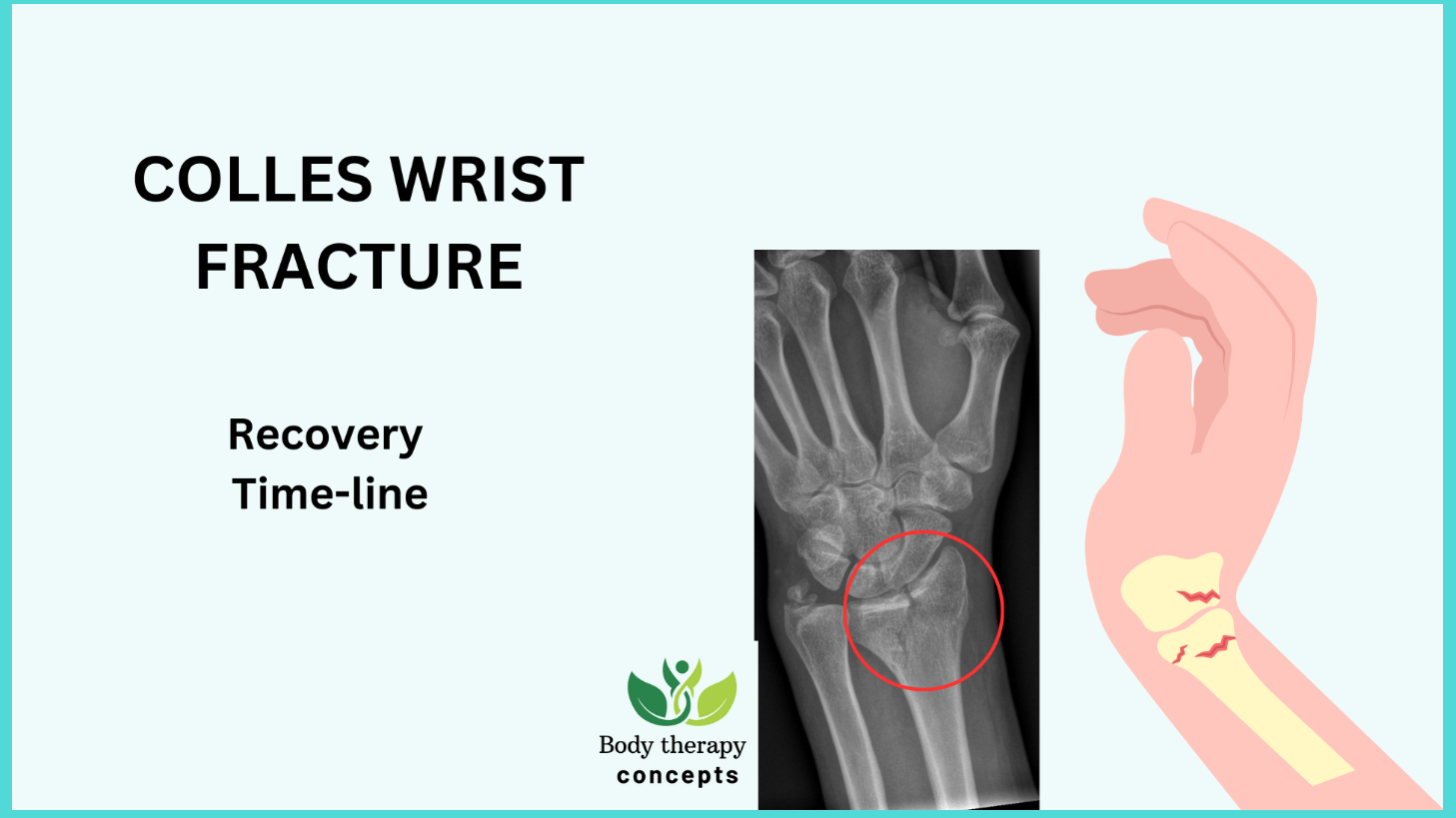 How long do Colles’ fractures take to heal?